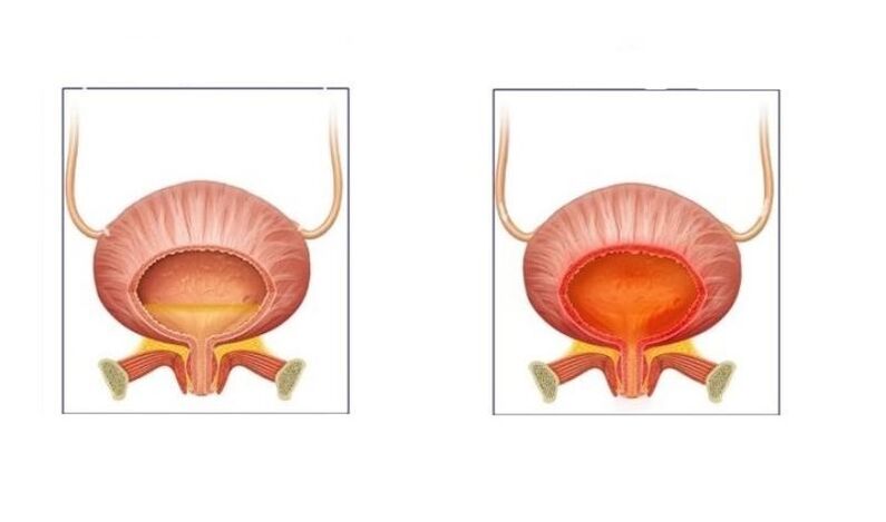 Normalno i bolesnici s cistitisom mokraćnog sustava