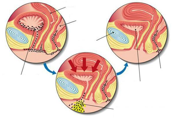 bakterije u mjehuru s cistitisom